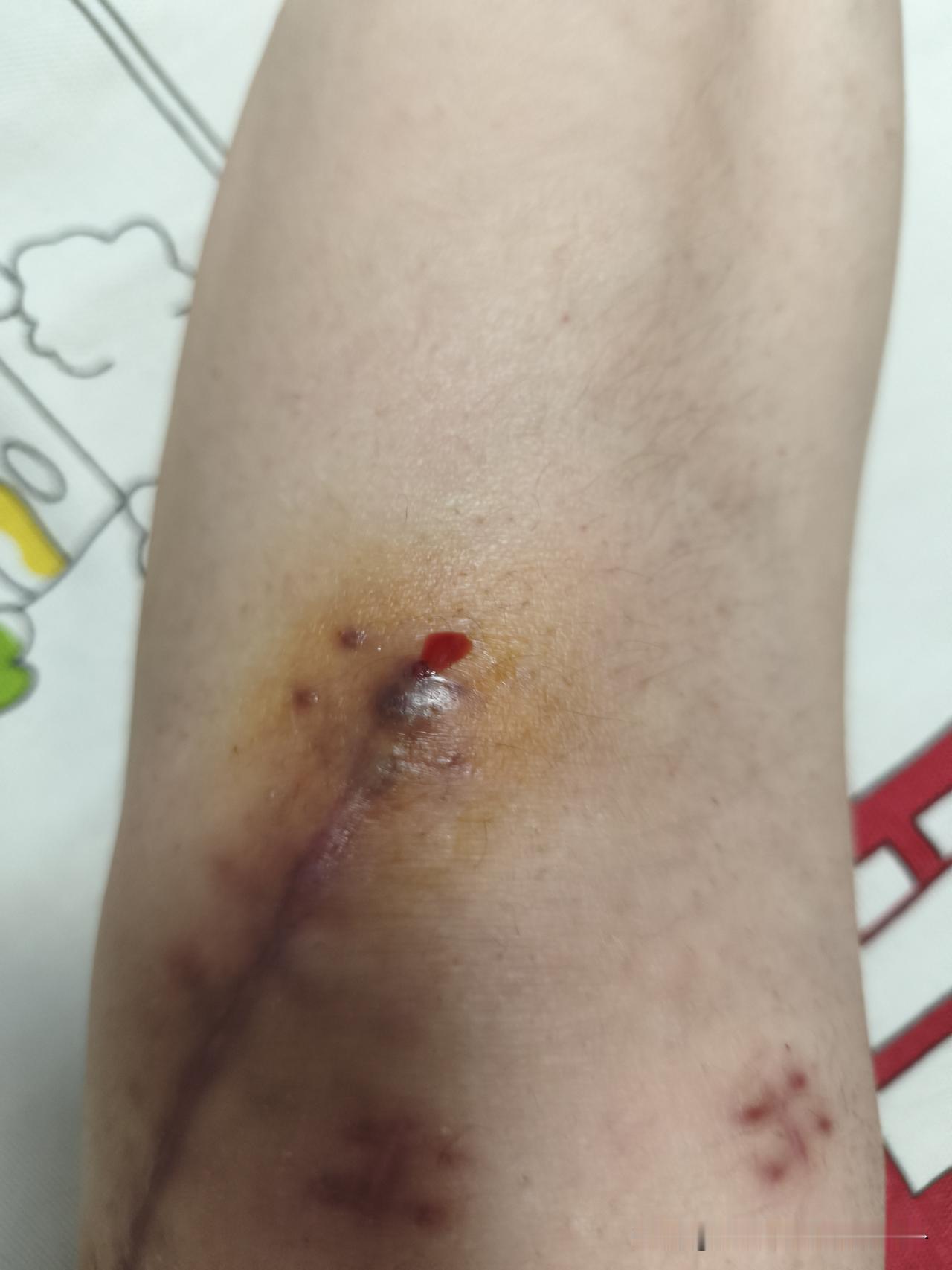 6月1号被外卖骑手撞骨折，所有手术医药费都是我们自己想办法解决，外卖骑手不露面，