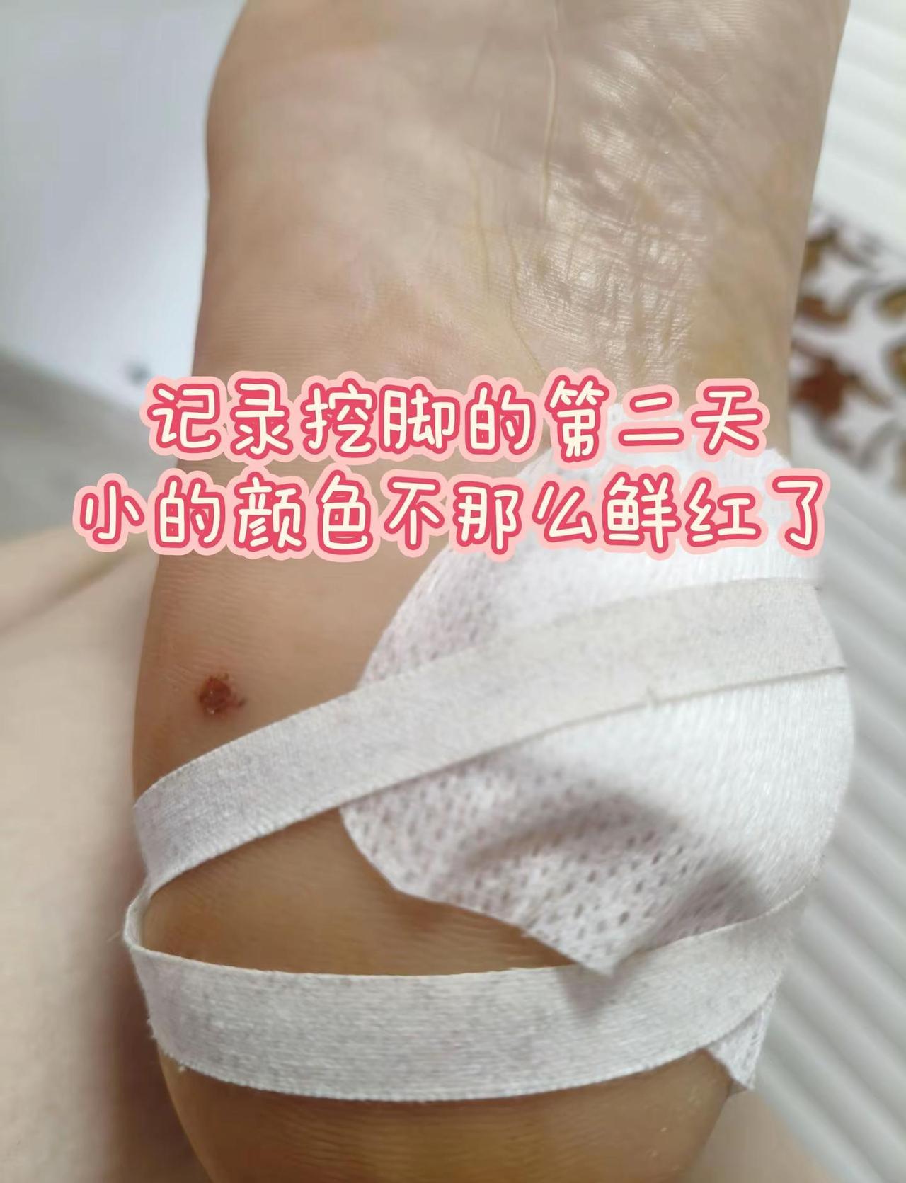 挖脚上的黑痣。我要上热门 做掉黑痣的第二天，昨晚睡觉有些疼感觉，小的伤口颜色不那