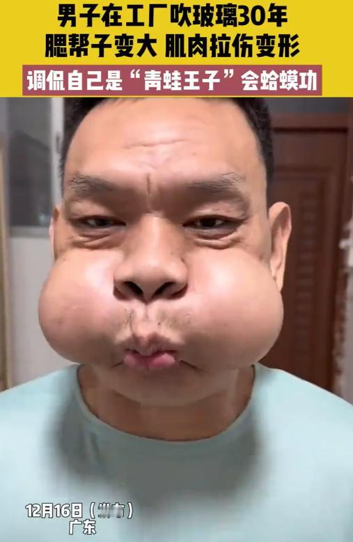 这个真笑不出来！广东一男子在工厂干活干了30年，因为常年都要吹玻璃，导致两个腮帮