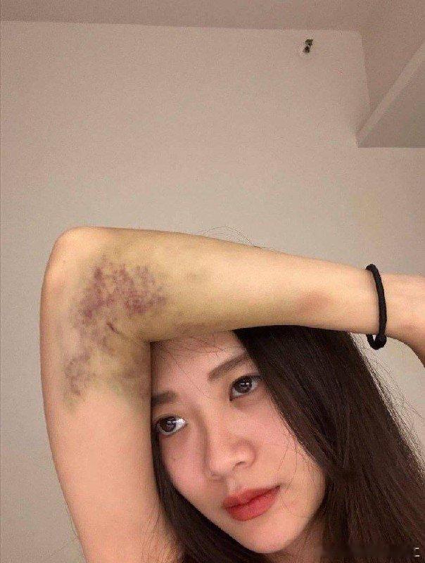 天呀，被打成这样[费解]？？ 