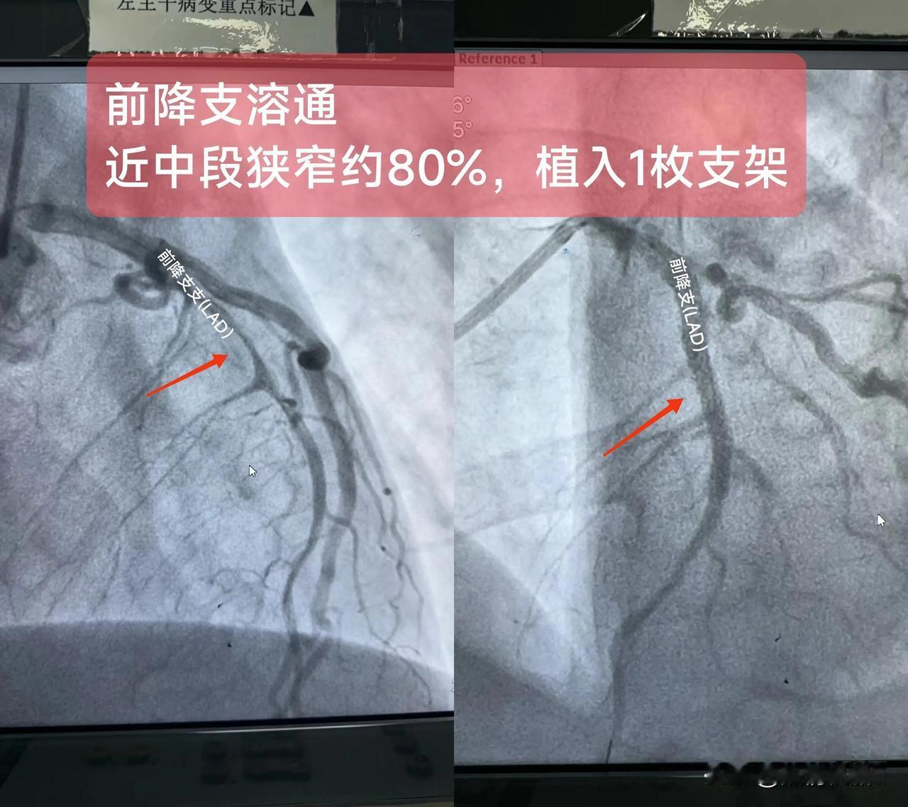 急性ST段抬高型心肌梗死
（前降支近中段狭窄80%，溶栓已通)

一.概念：
冠