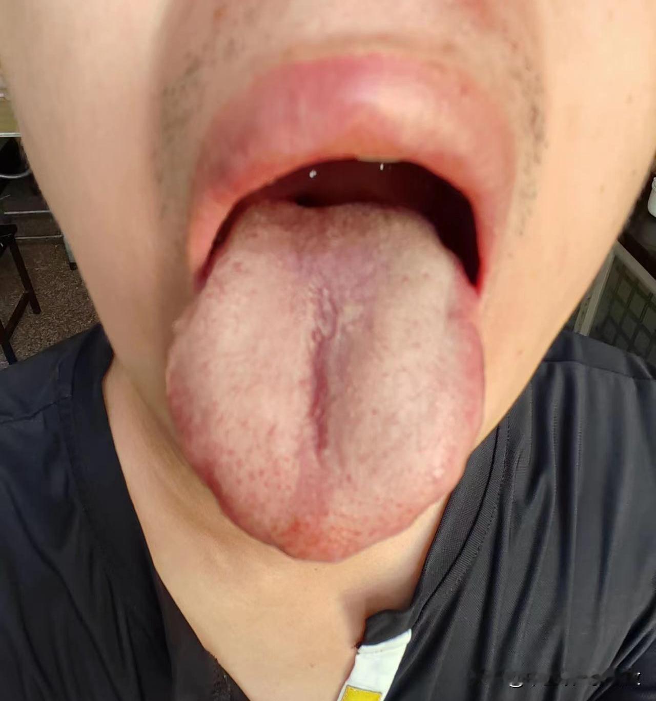 我就纳闷了，20来岁大小伙，咋搞的一身问题[狗头][狗头][狗头]
主诉：口干口