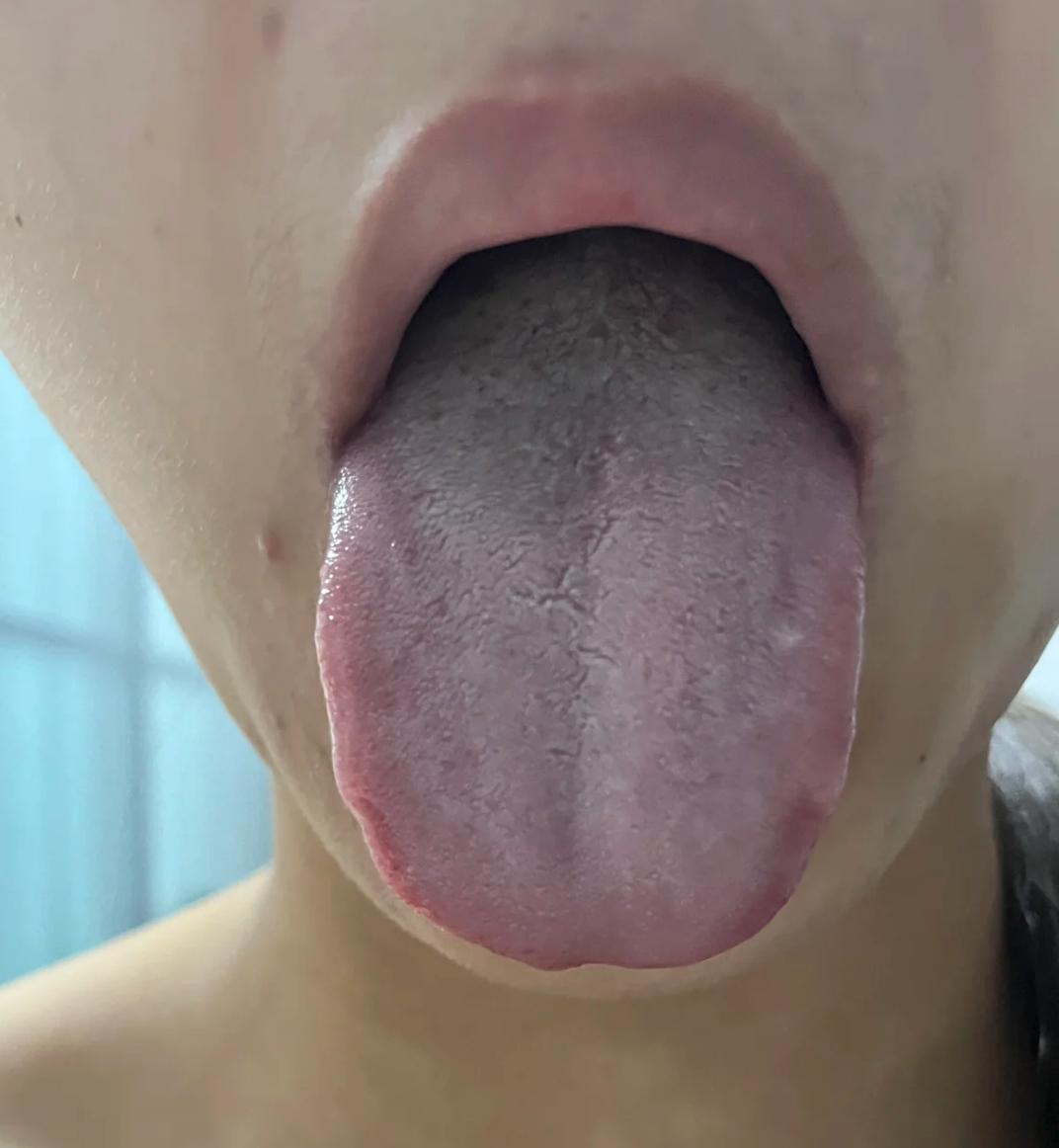 这样的舌头，你可别以为没事，越拖越麻烦的！
凡舌上有裂纹者，不用管具体症状有多少