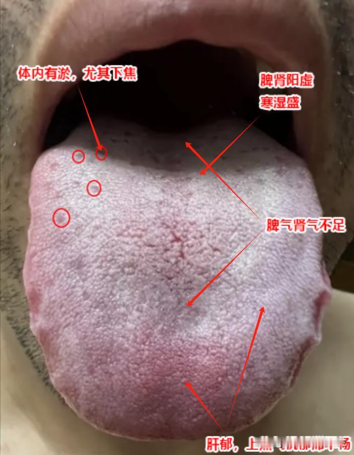 这种舌象，健脾疏肝，补阳也没多大用处！
为什么说这种舌象用很多健脾疏肝，补阳的方