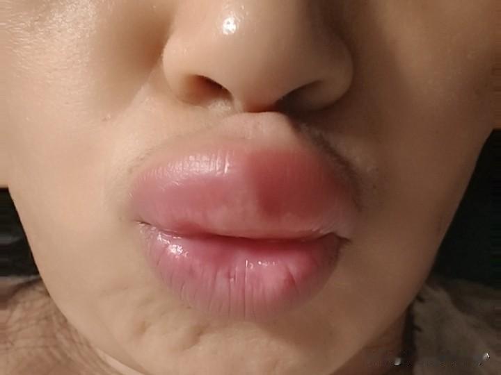 豆包真的可以当医生了…

饭后吃了个西红柿，就蹲在那栽花，突然越来越感觉上嘴唇不