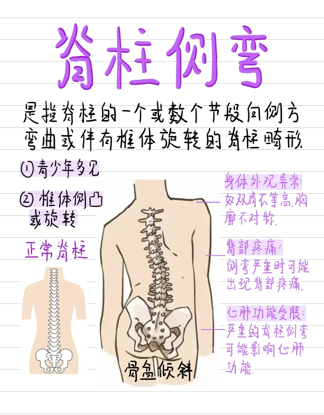 医学生笔记-脊柱侧弯 自查❗