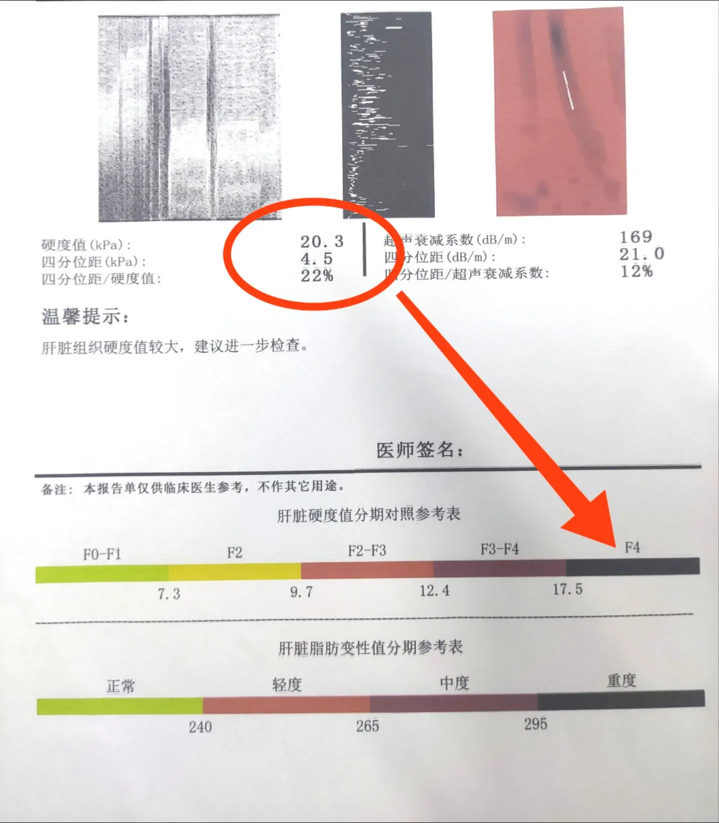 临沂肝硬化患者咨询：肝硬度值20就是肝硬化了吗？ 一般来说我们正常肝硬...