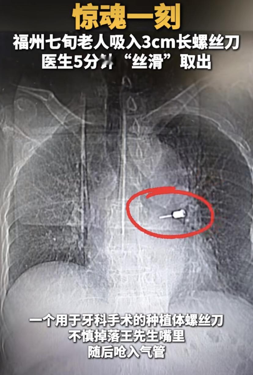 福州一男子看牙遭遇"螺蛳刀飞进肺"!医生手滑，3厘米金属物直插气管
福州有位王先