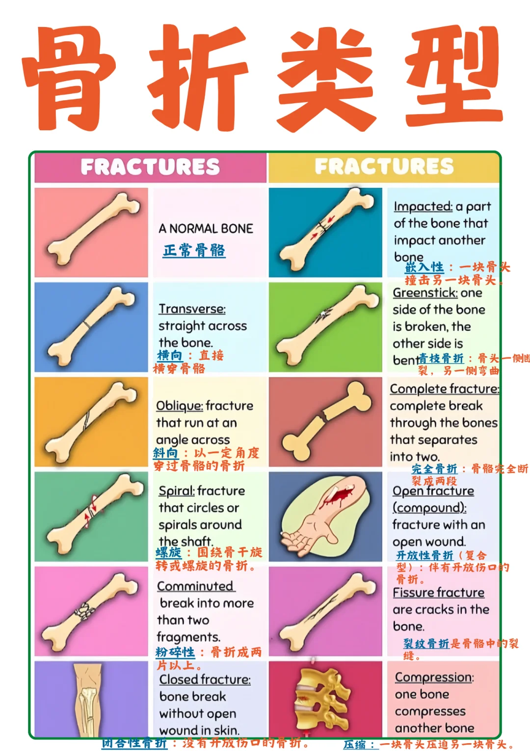 备考RN/骨折类型！！学！！单词