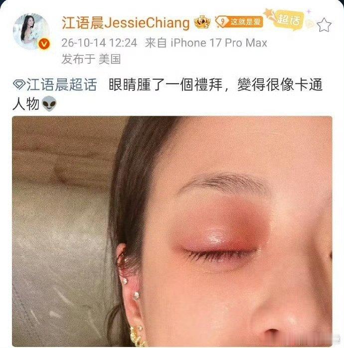 江语晨本人今天回应了麦粒肿，直言“嘶～超痛”，称医生判断两三天就会好。但有粉丝透