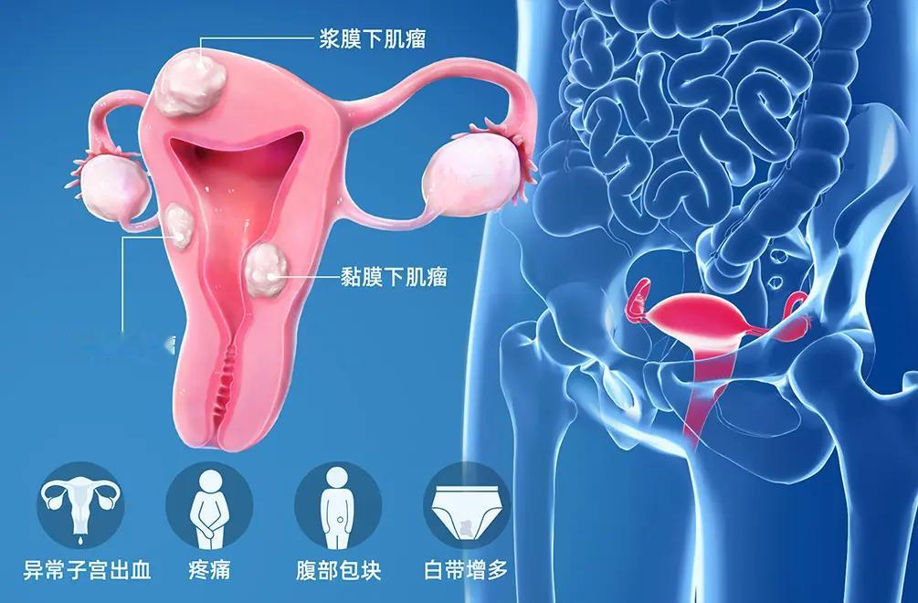 22厘米子宫肌瘤钻进40岁女子心脏目前医学对于子宫肌瘤形成的原因还没下明确的定论