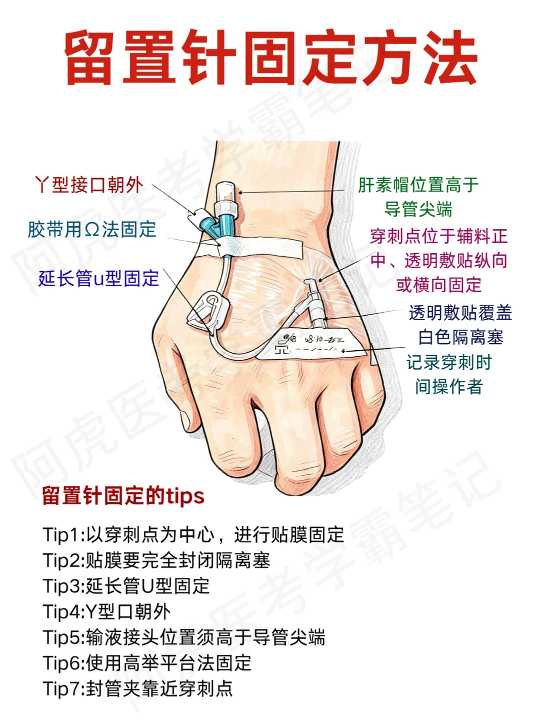 医学生笔记📒：留置针固定方法👆