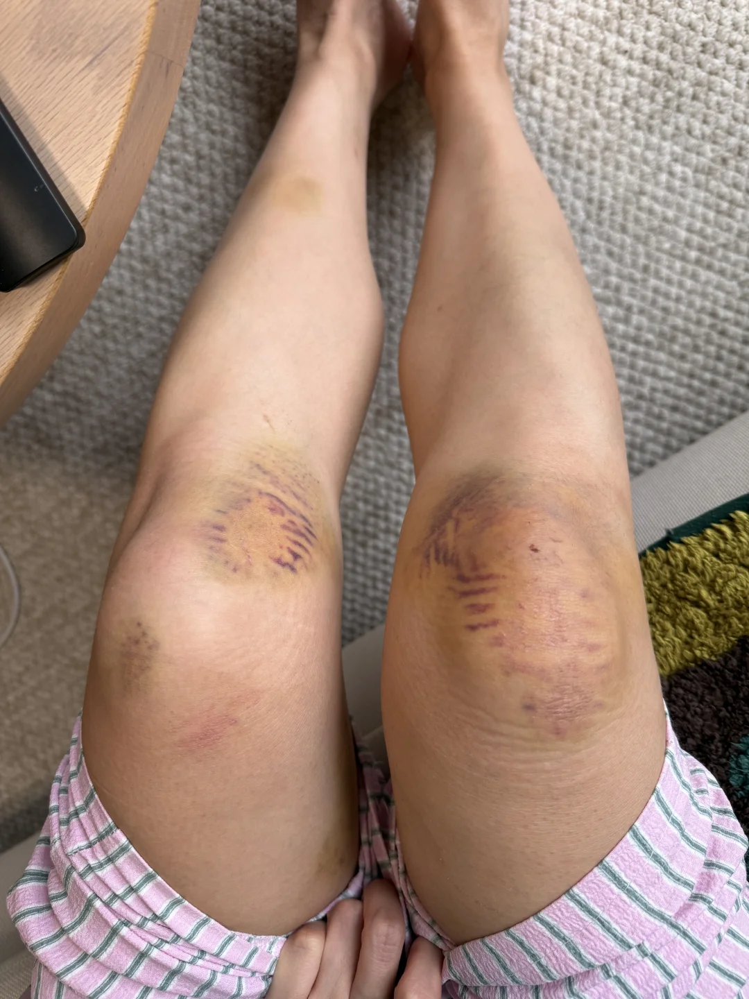 湿性愈合好神奇啊