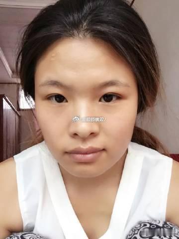 额头暗沉，早年运势不太好，家庭一般，少得父母和长辈的帮助，再加上右额头处有疤痕，此处是父母宫，说明父母健康方面差，父母缘薄，官禄宫处有凹陷，对早年事业有一定的影响，山根凹，在婚姻上会不顺利。但是鼻子高挺且鼻头圆润饱满，财运是有的，不过鼻孔稍有外露，建议平时在花销上多注意，避免不必要的破财漏财。