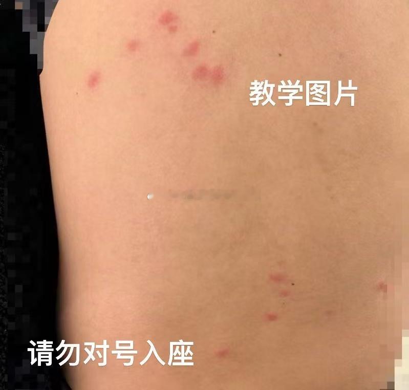 小情侣搞瘫医院挂号系统双双获刑是带状疱疹还是虫咬皮炎住院总的那些日子 ​​​