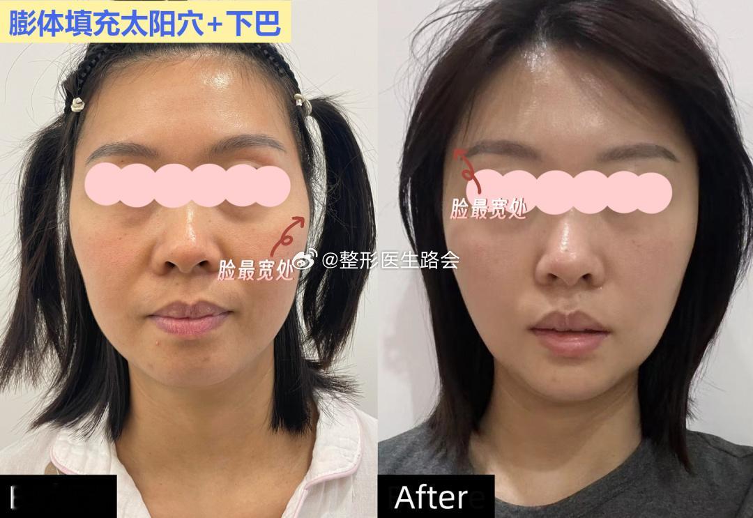 太阳穴凹陷+下巴后缩有多显老？做完膨体填充，说说我的真实变化！  一直...