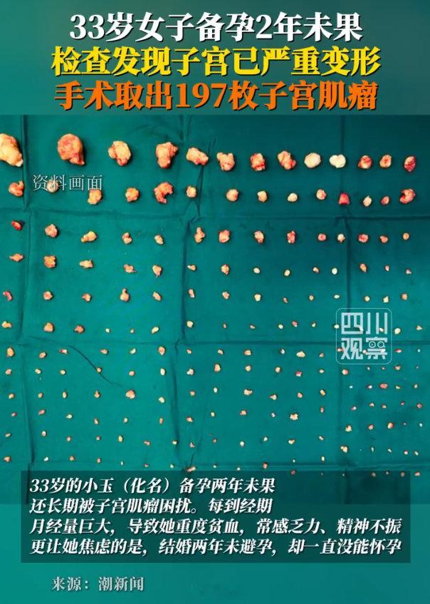 33岁女子备孕2年未成功，一检查，从子宫取出197枚子宫肌瘤…主刀医生坦言，这是他遇到的肌瘤数量最多的一例。所以，生育要趁早，早生育能解决绝大多数问题，生育晚了，到处都是问题…

#女子备孕两年未果取出197枚子宫肌瘤# ​