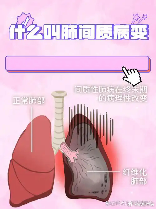 特发性间质性肺炎与继发性间质性肺炎的区别：
 核心一句话：
特发性＝找不到明确病因；
继发性＝有明确原因诱发的肺间质损伤。
✅ 1. 病因区别；
 特发性间质性肺炎（IIP）；
 - 没有找到明确诱因，排除所有已知原因之后才能诊断
- 属于一组独立的肺疾病，包含多个亚型：特发性肺纤维化（IPF，最常见） ​