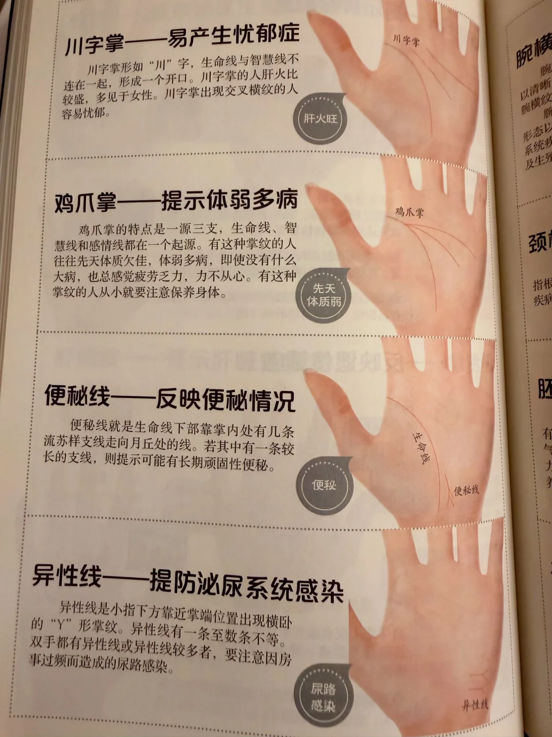 便秘线，反映便秘情况