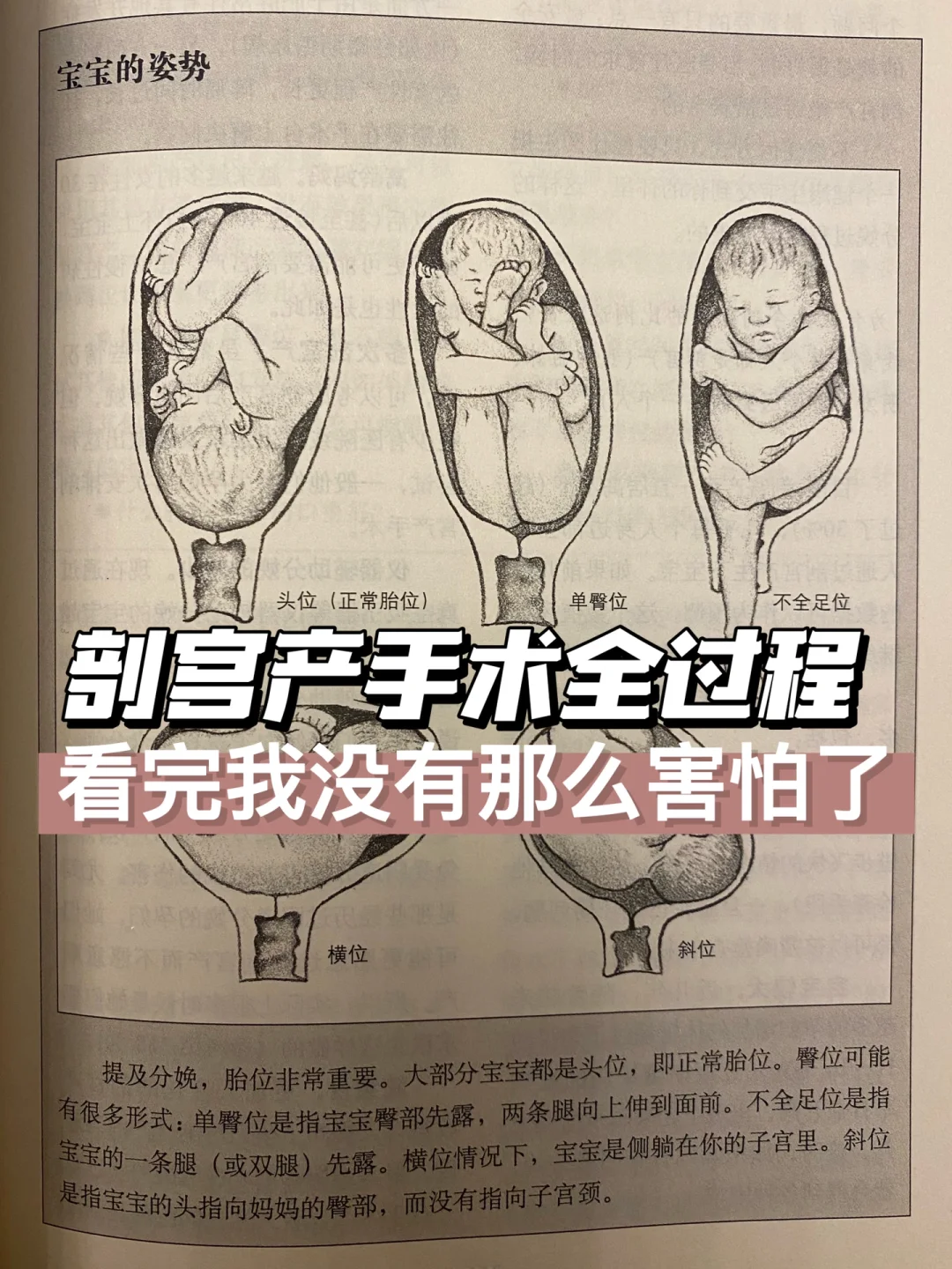 🤰剖腹产手术全过程❗️看完我没那么害怕了‼️