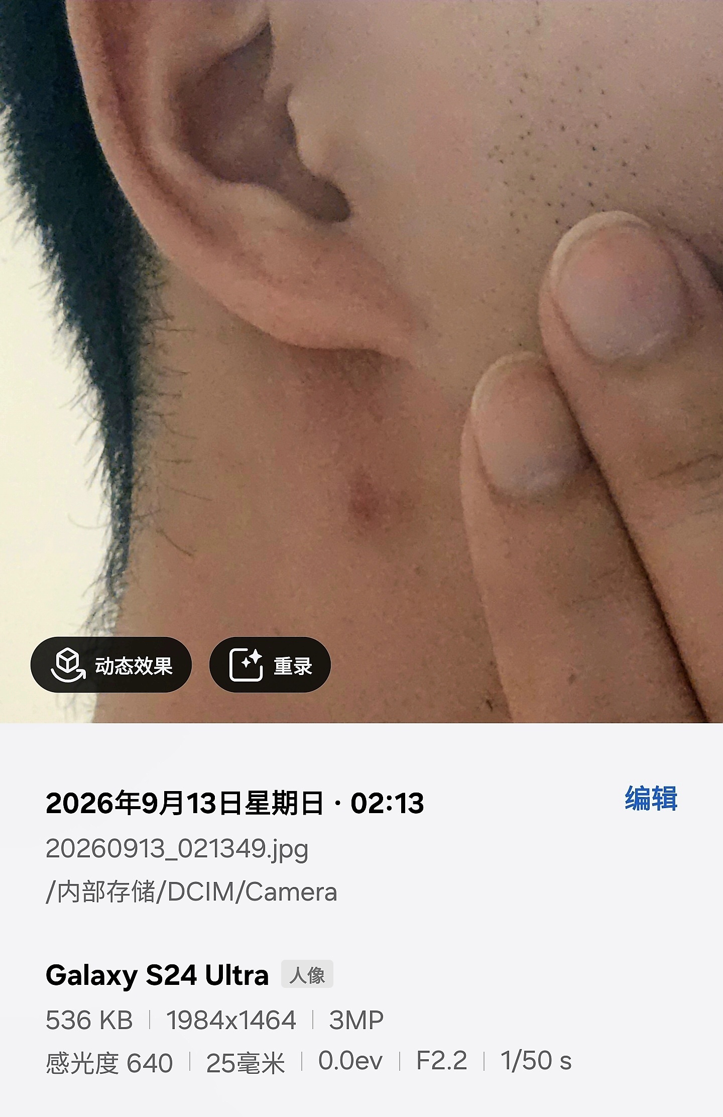 痘反馈：这种大的结节痘是真难搞哈😅体积小了点，深红色范围也小了点继续记录[二哈]之前的贴： ​​​
