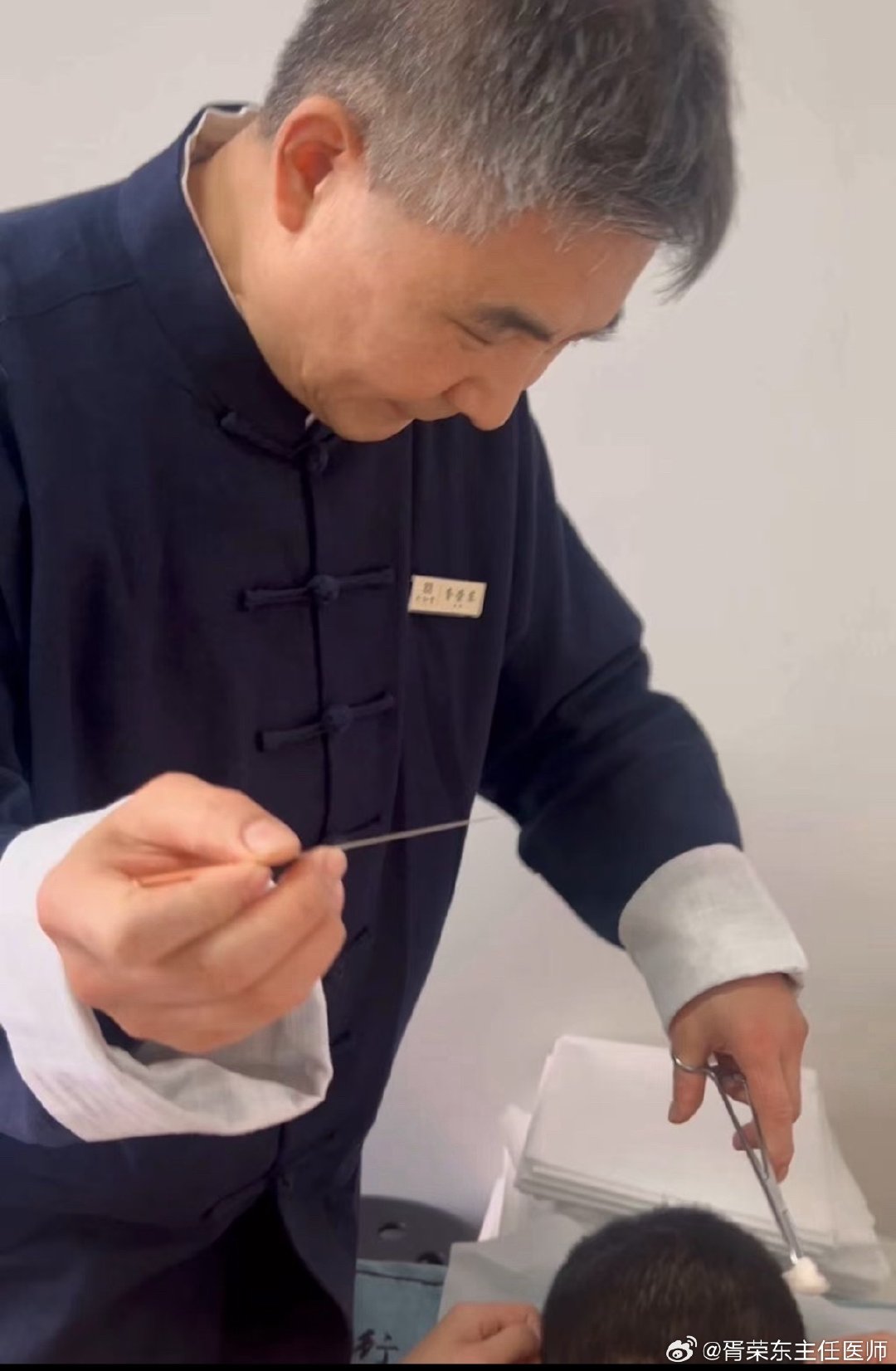 三叉神经是混合神经，也是面部最粗大的神经，含有一般躯体感觉和特殊内脏运动两种纤维。由眼支（第一支）、上颌支（第二支）和下颌支（第三支）汇合而成。三叉神经痛就是大家所说的“脸痛”，出现这种症状是很容易与牙痛相混淆的。常有人拔牙后还痛，才知道是三叉神经痛，针灸疗效好。 #中国镇痛周##无痛中国带你科学管理疼痛#