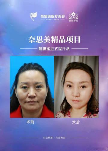 整体来说还算是可以，就是眼周衰老严重，眼袋、泪沟都特别严重
苹果肌塌陷下移、面颊双侧凹陷严重、鼻唇沟凹陷严重，面颊赘肉多‼️
口角下垂、口角嘟嘟肉、还有就是下颏不清晰，面部整体凹陷严重
筋膜递进式提升术后面部凹陷几乎不见了，面部的组织也都归位了，苹果肌相对之前对比比较饱满，鼻唇沟、 ​