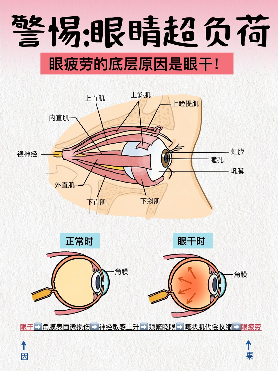 眼疲劳是果，眼干才是因