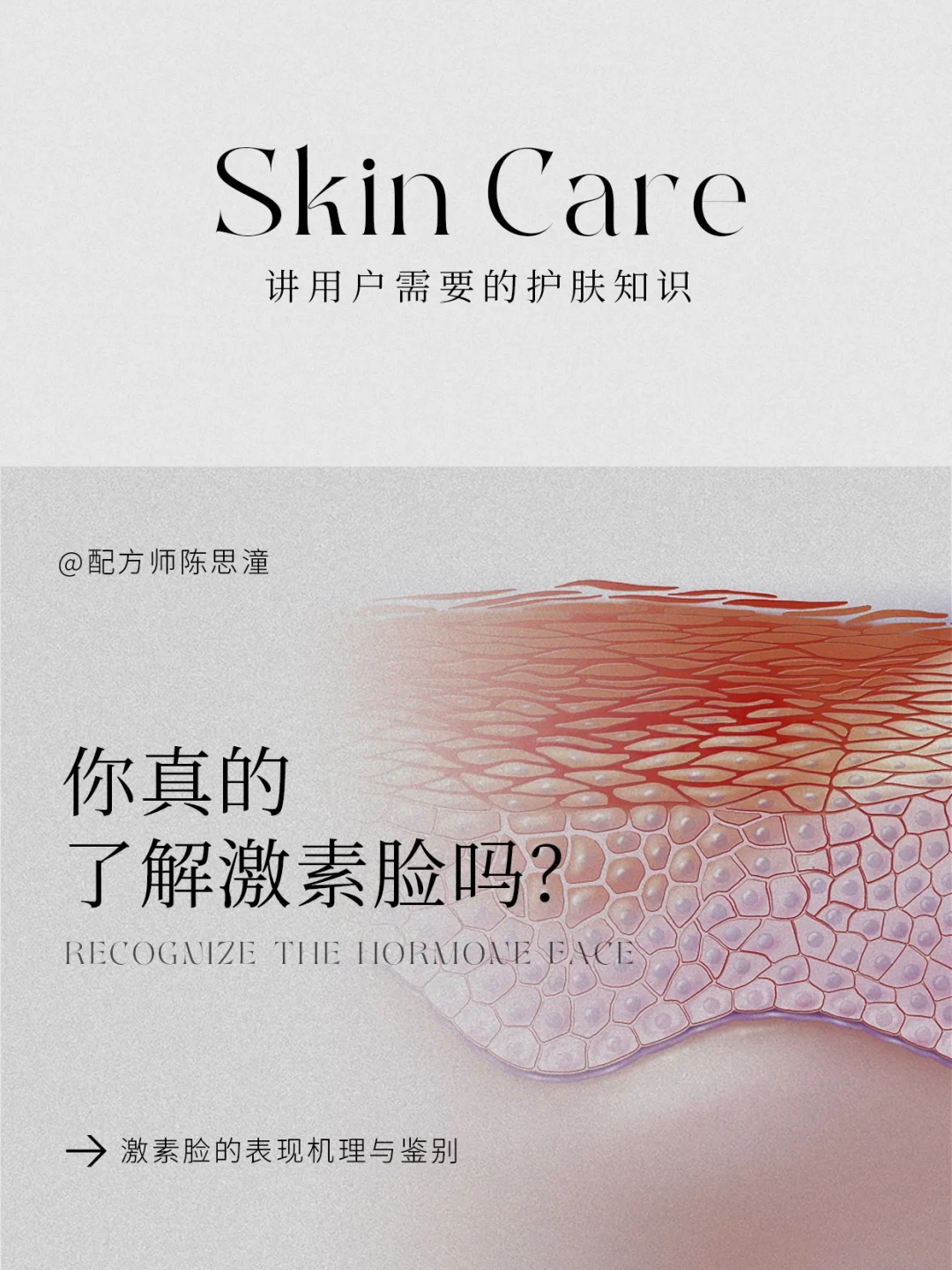 护肤知识｜你真的了解激素脸吗？表现和鉴别