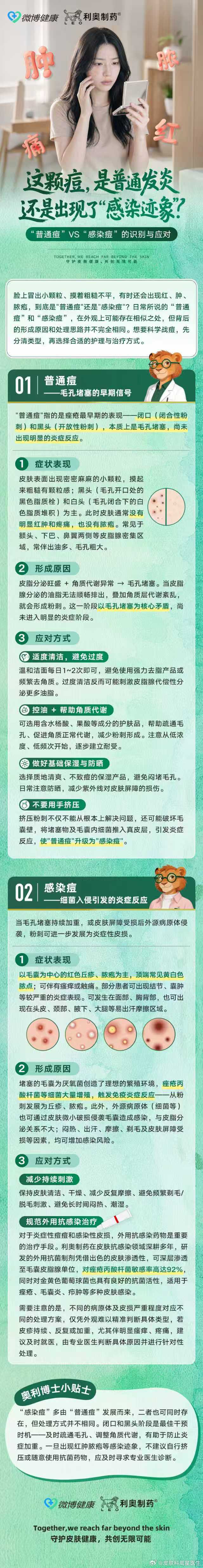 #皮肤问题到底让人有多崩溃#
每年9月第三周是中国痤疮周，今年已是第九届。但临床上每天仍有大量患者因为踩了护理误区，把小痘痘折腾成大问题。今天带大家逐一拆解👇

🔴 误区一：所有痘痘都一样，挤就完了？
大错特错。痘痘分两种，处理方式完全不同：
✅ 普通痘（闭口/黑头）：皮脂和角质堵塞毛孔形成，无感染，以疏通毛孔为主，轻者温和清洁+规律作息即可改善。
❌ 感染痘（红肿脓疱）：摸起来发硬、按压有痛感，说明细菌已侵入毛囊深层引发炎症，需要抗炎抑菌，严禁挤压！

🔴 误区二：红肿痘冒出来，挤掉就好得快？
不挤还好，挤了可能更糟。面部危险三角区的痘痘尤其不能碰，挤压会让炎症向深层扩散，轻则留痘印，重则颅内感染。
正确做法是：红肿痘刚冒头时，局部点涂抗炎抑菌药膏，例如利奥制药的立思丁夫西地酸乳膏（通用名：夫西地酸乳膏），对痤疮丙酸杆菌、金黄色葡萄球菌等均有抑菌作用，适用于寻常性痤疮等皮肤感染。大面积反复发炎一定要及时就医，规范治疗。

🔴 误区三：感染痘只是‘上火’，不用抗感染？
一项...
