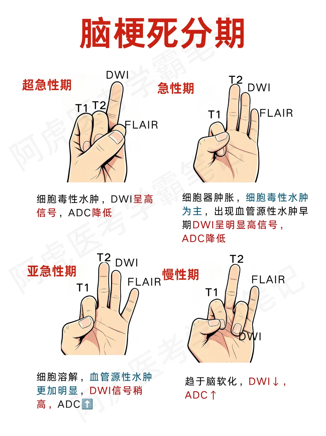 阿虎医考笔记📒脑梗死分型❤️
