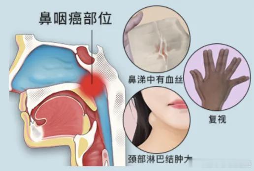#女子长期鼻塞查出患癌##健闻登顶计划# 分清鼻炎与鼻咽癌信号！这几个危险征兆别混淆
 
秋冬换季、受凉感冒后，鼻塞、流鼻涕是很多人的常态。绝大多数人出现鼻部不适，都会默认是普通鼻炎，草草用药、不予重视。
 
但很多人不知道：鼻炎的鼻塞是小问题，而鼻咽癌的早期信号，常常伪装成“久治不愈的鼻 ​