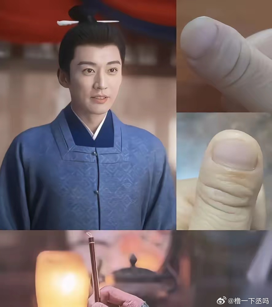 刘学义这手，一伸出来，弹幕直接炸了。 
拇指短粗，指甲盖又扁又平，末端像个小鼓槌。医生管这叫杵状指。网友全在晒同款，说这手比他那张脸还出圈。 
别急，这玩意儿不疼不痒，但医学上真有讲究。大部分跟肺子和心脏缺氧有关，七八成病例查下去是呼吸系统的毛病。也有天生的，遗传来的，啥病没有。 
剧 ​