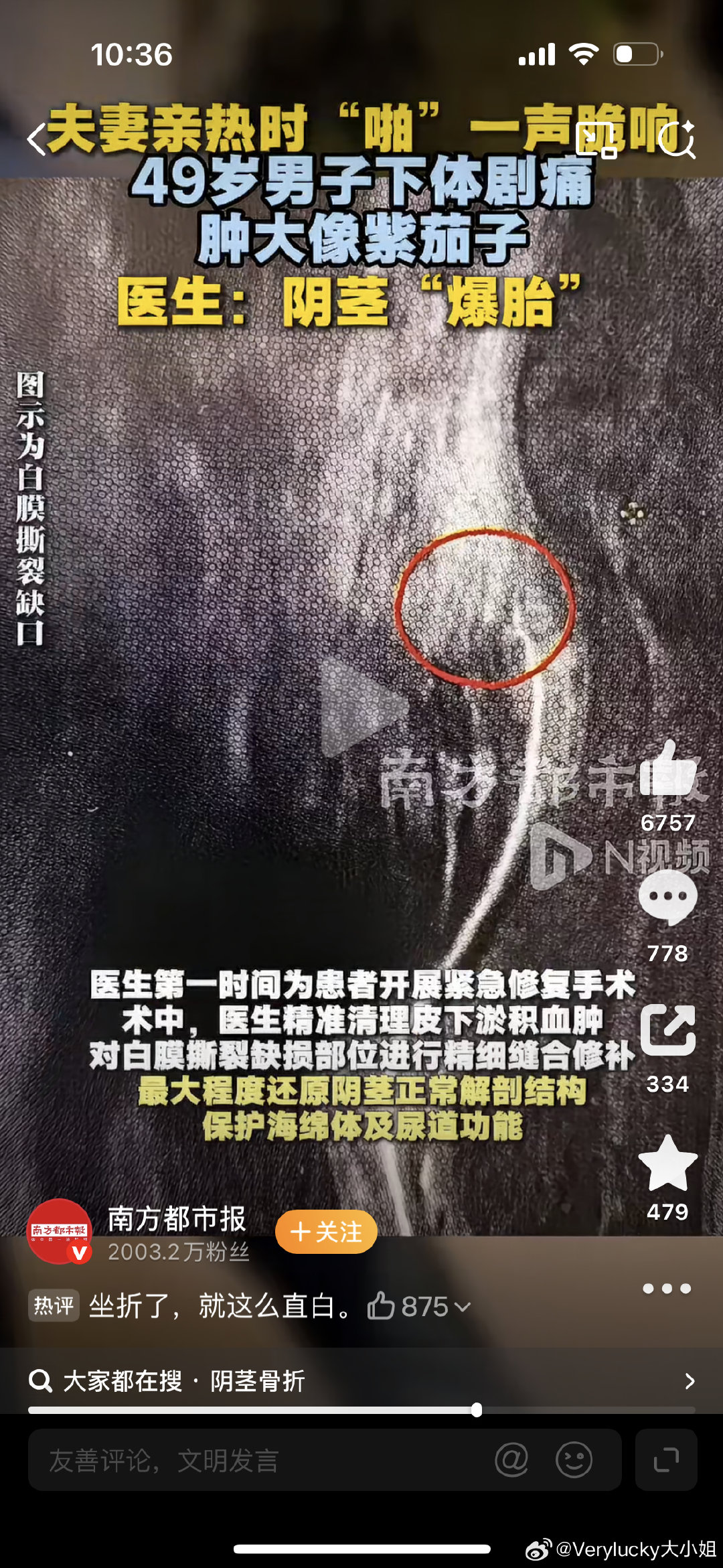 杭州一名49岁男子在夫妻亲热时，因动作幅度过大，下体突然传出“啪”一声脆响后剧痛肿胀成紫茄子，被确诊为俗称“阴茎骨折”的海绵体白膜撕裂。 一、事件经过- 突发意外：凌晨2点，49岁的季先生被妻子搀扶进