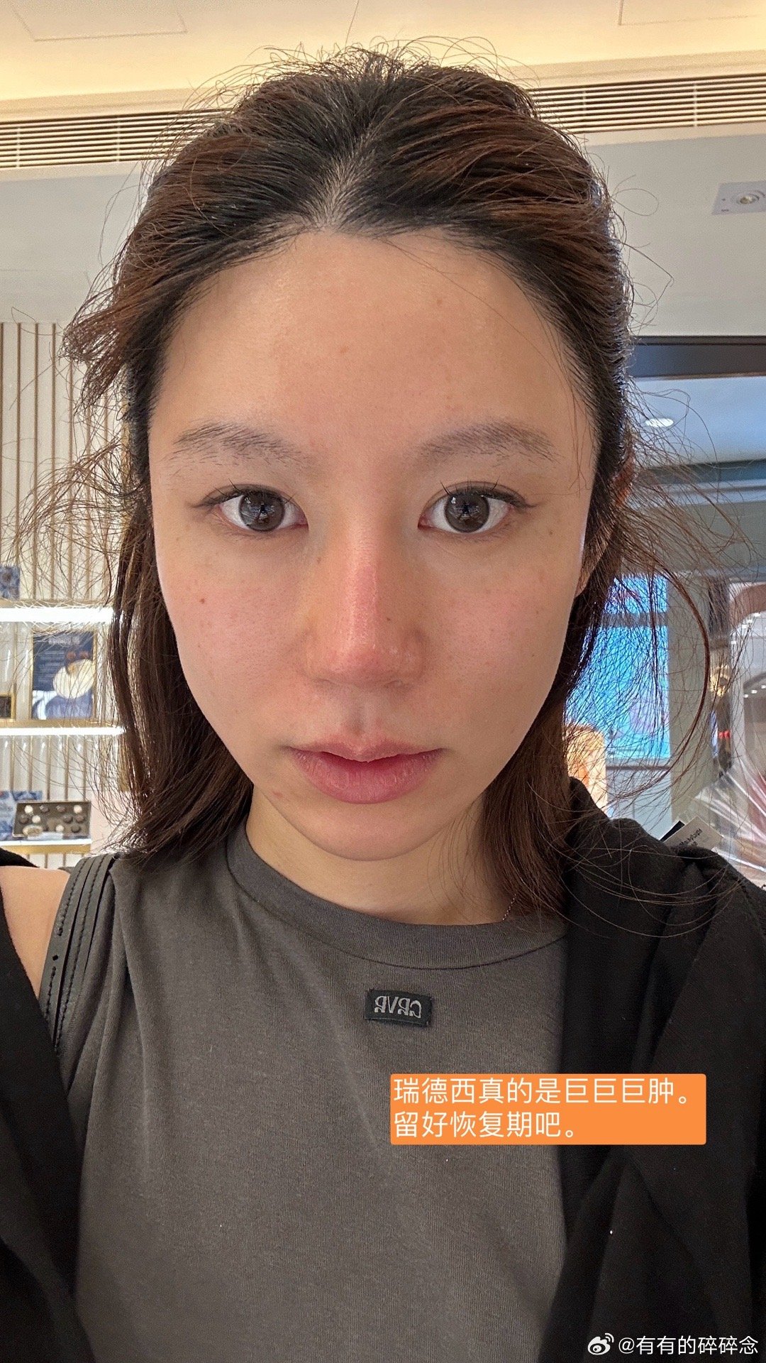 记录下1：小苹果肌凹陷，用保柔缇橙1ml顶起来了。皮薄的紫紫会很喜欢，吸水性弱，不抛，前提是你只搞一支啊，你要搞三四五那也是不行的。苹果肌这个位置，我不知道大家有没有打过别的材料，我看别人打乔在苹果肌这个位置，一顶眼睛就会小一圈。保柔缇橙我去年打过，也是打的这个位置，可以在微博有宝hk功课 搜搜功课。我自己亲身体会是它的融肤度比较好，表现在做表情的时候不会把眼睛挤小。2:用索肤波把苹果肌下缘不平整的肉压平，100 发，只购苹果肌或者是口周，2600rmb，非常非常便宜，做超声炮不如做这个。这是我第二次打索肤波。不可否认它是有用的:我自己的体验是即刻去水肿，不肿，一个月以后能感觉到组织被压平。唯一缺点就是痛。其实它在有肉的地方，比如说苹果肌是不痛的，但是碰到骨头的时候，像针扎一般的疼痛。肉肉脸姐妹真是血赚，体感会好特别多，而且也可以打比较高的能量。。像我一样，就是脸上没什么肉的姐妹，我只能说祝你好运，aplus有冷风机会好一些，但还是痛，不知道吃布洛芬会不会好一点。我第一次是去 Dr...