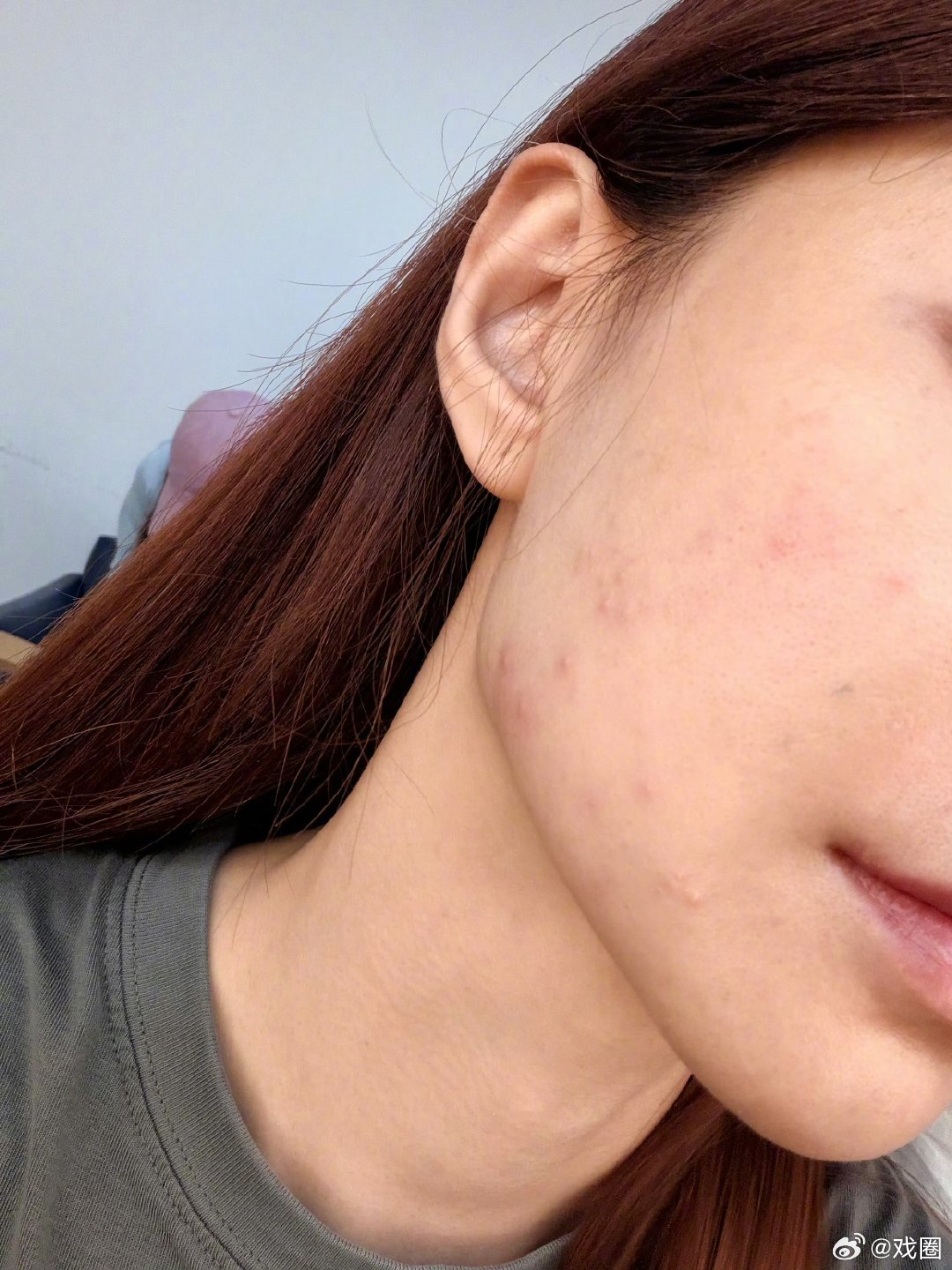 沈梦辰回应脸过敏，真觉得她一点架子都没有。素颜直面过敏，还安慰大家，真...