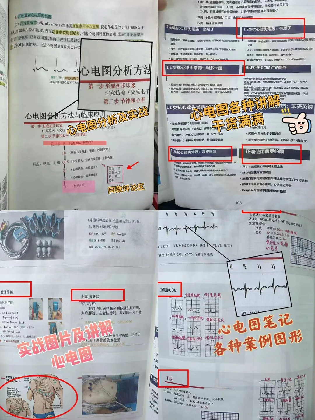 规培医学生心电图笔记19