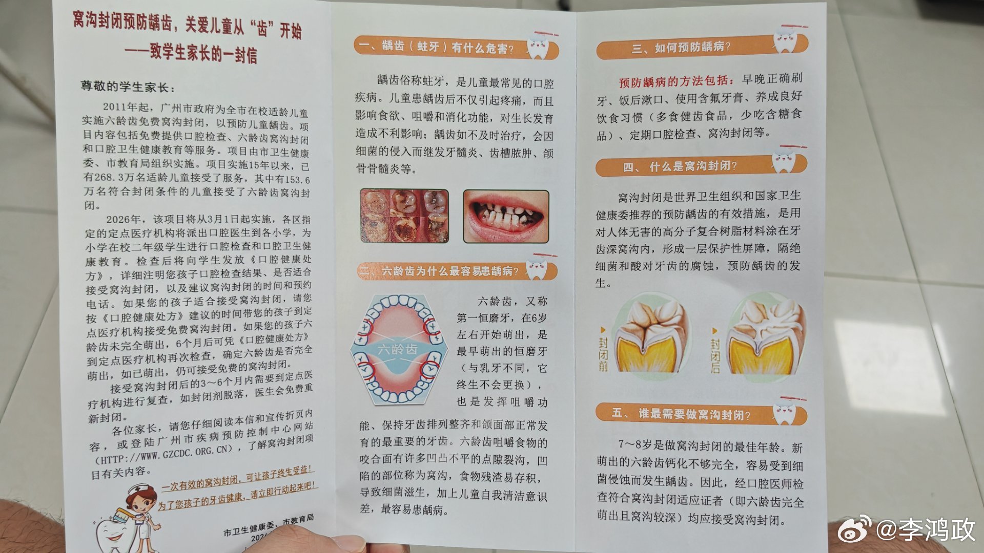 广州市二年级同学可以免费做窝沟封闭，做的是六龄齿，一共四个，上下左右各...
