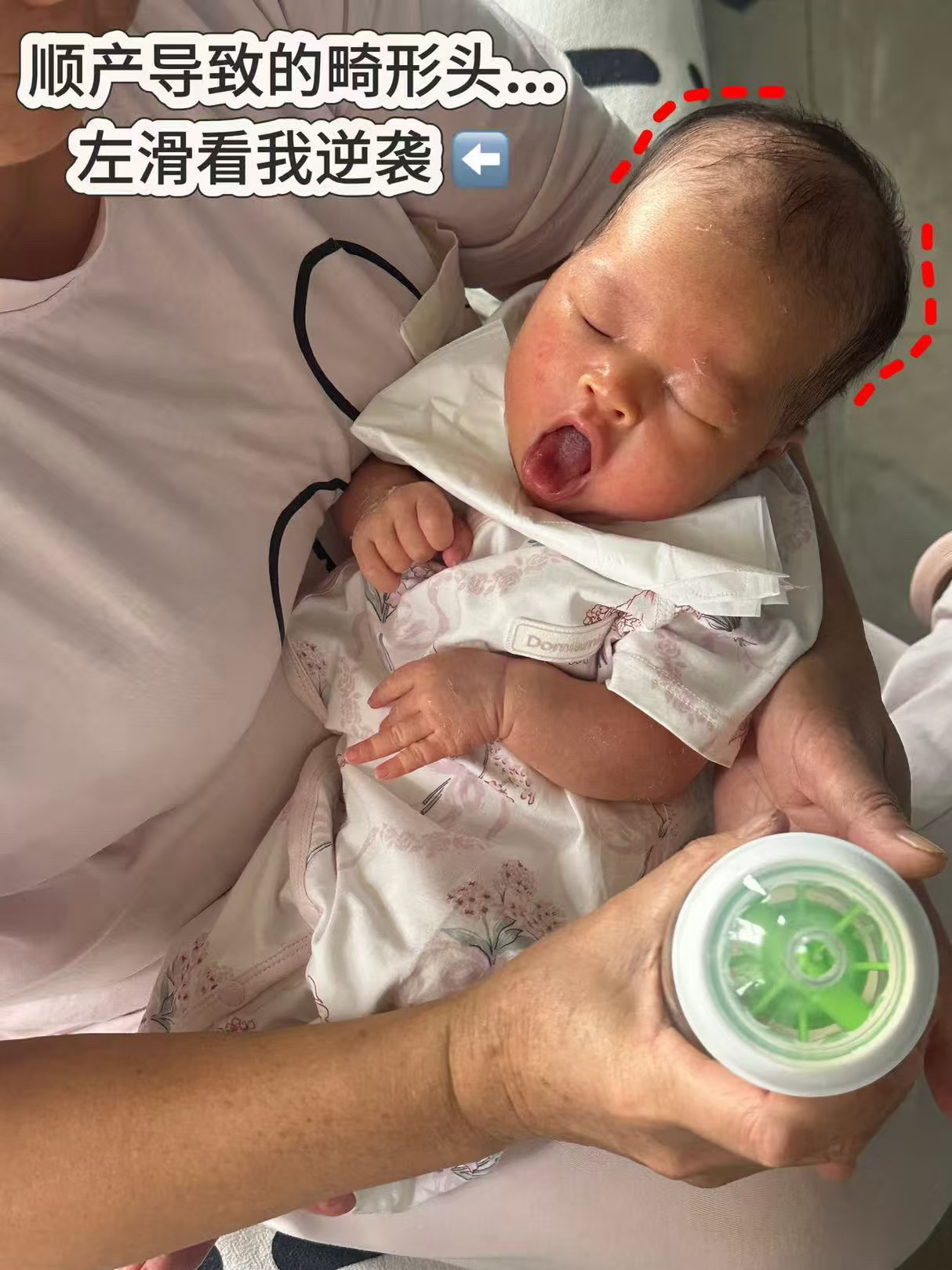 不用头盔，把顺产挤压的畸形头睡圆了