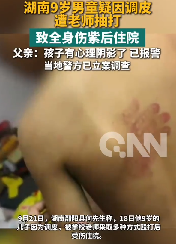 湖南，一个9岁男孩，因为调皮，被老师打进了医院。当天，男孩和班上5名同学用扎了孔的矿泉水瓶互相滋水玩，水溅到了女同学头发上。老师先拿竹棍抽打包括儿子在内的6个孩子，随后又单独把儿子拎出来，用塑料板击打后背和膝盖。当晚孩子就发起高烧，送医后医生掀开衣服一看：全身伤紫！
 
这名受害男孩化名小轩，今年年