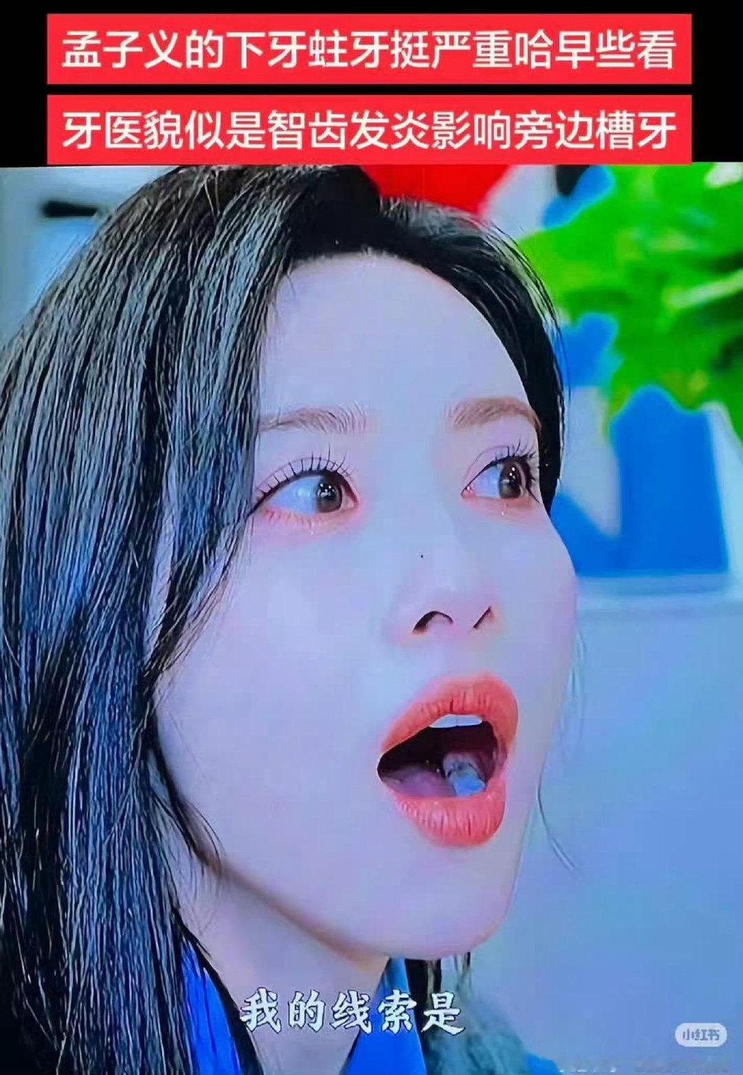 马上要录尚公主剧宣了，孟子义补牙了吗，口气管理请做好，不要打扰到其他同事，有口气很烧心 ​