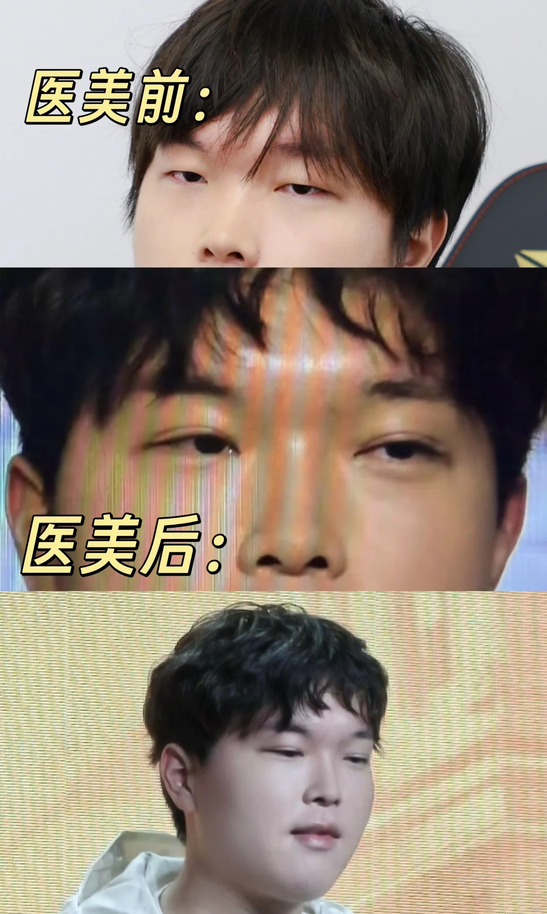 LPL首位医美选手 BLG Bin 👀