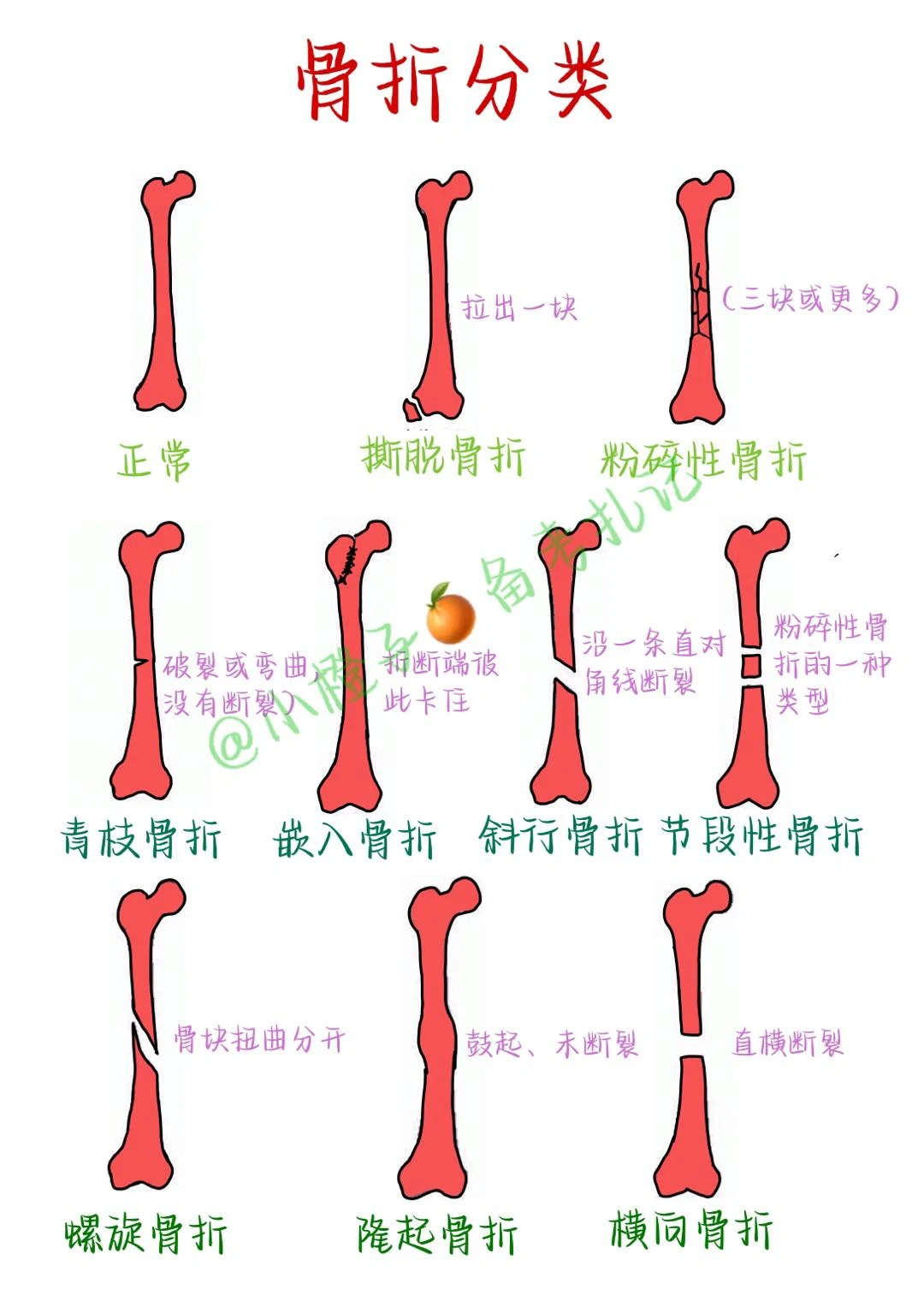 📖护师笔记｜外科护理学｜骨折分类🧐