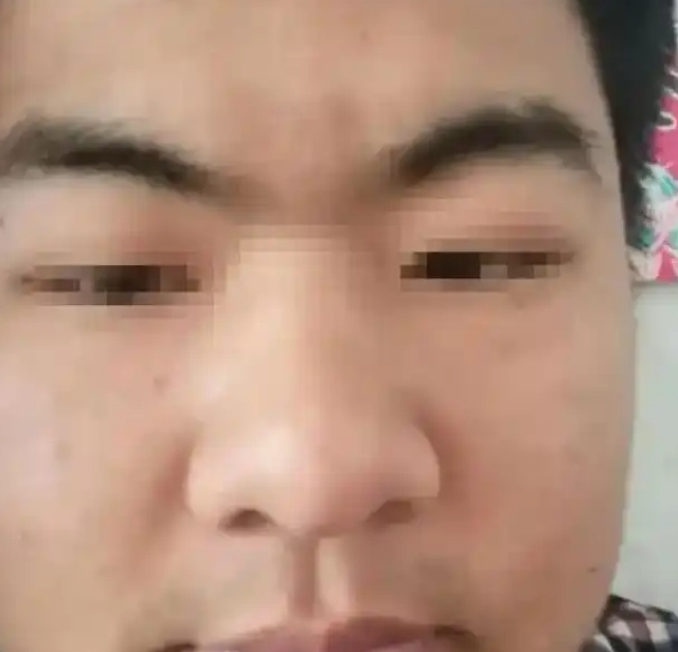 山根断现横纹，预示着未来三年必有重大变故，轻则事业受挫、财运暗淡，重则家庭变故。 ​​​