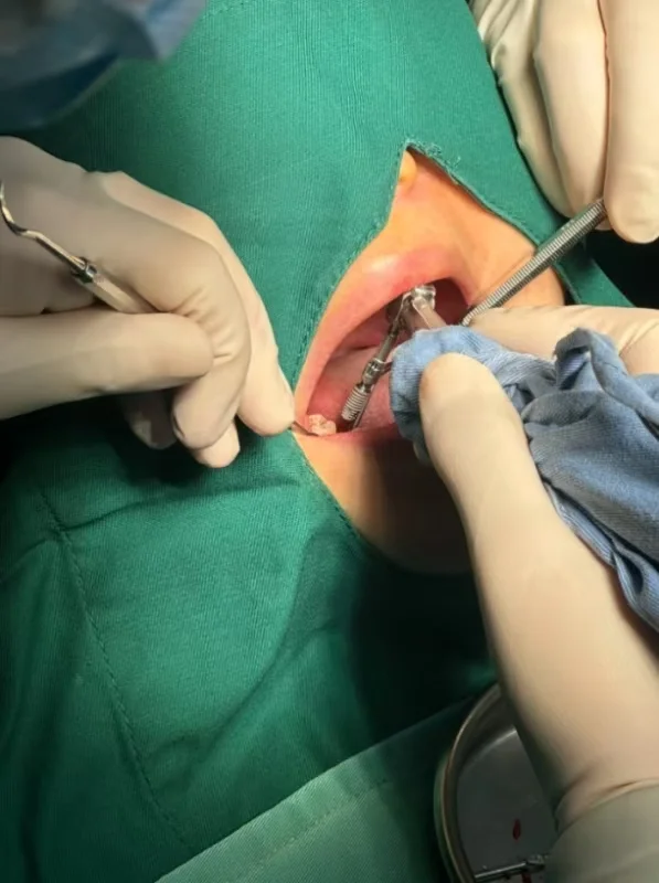 在广州不到2w种上两颗iti （一期记录）