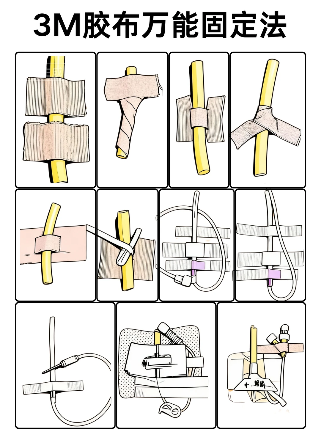 阿虎医考笔记：一文了“3M胶布万能固定法”