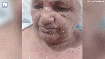 仨老嫗河邊捕魚遭蜜蜂群攻擊 72歲老太被蟄得滿臉毒針像撒瞭沙粒-圖4