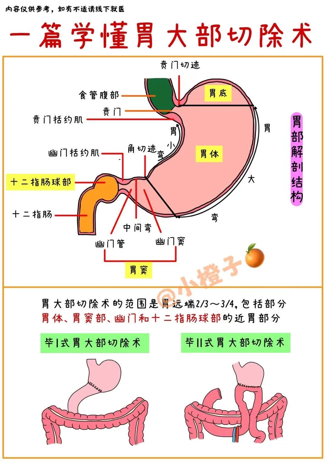 胃大部切除术✅一篇讲清楚‼️