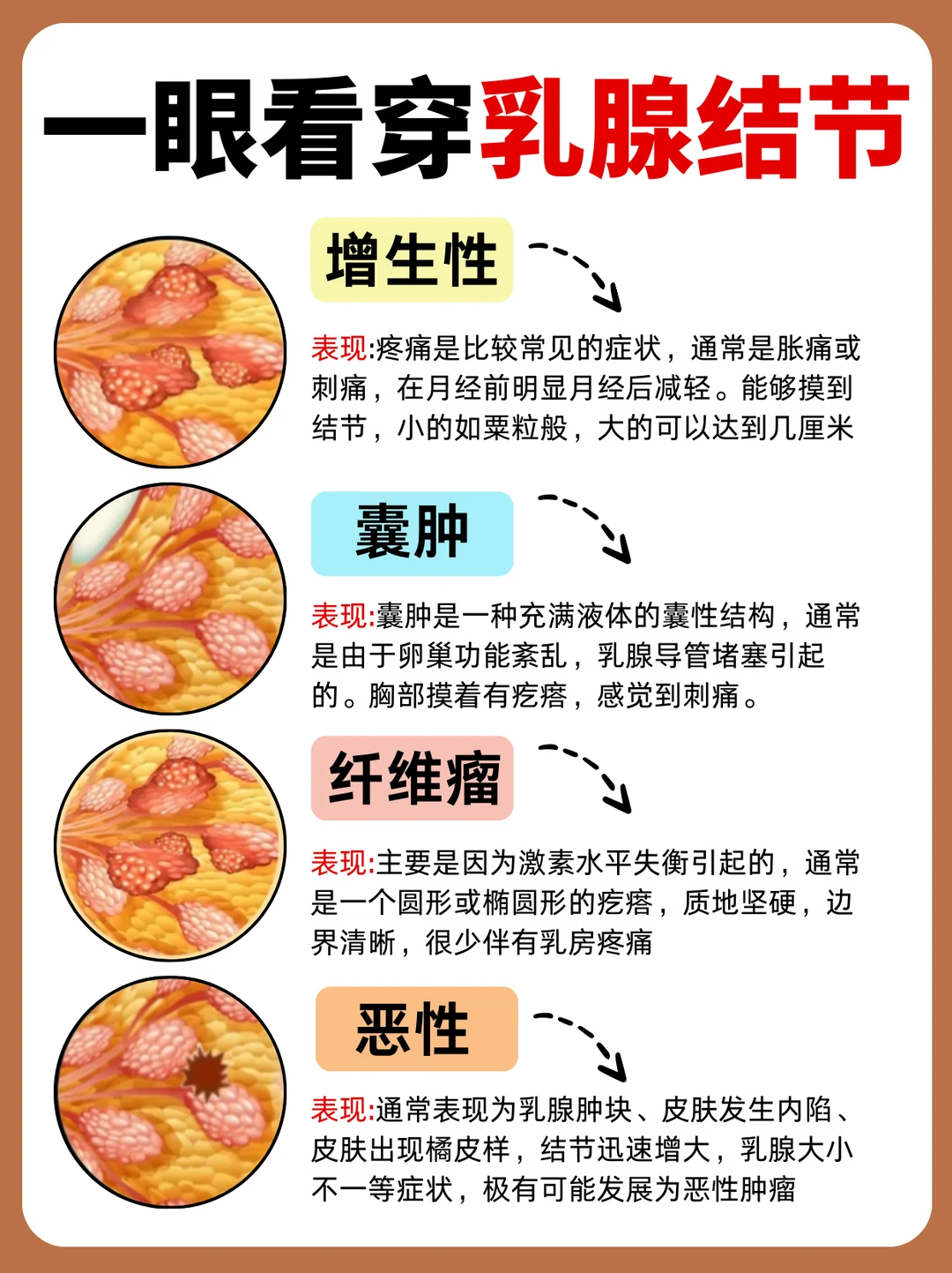 乳腺结节的四个等级？看看你是哪个？