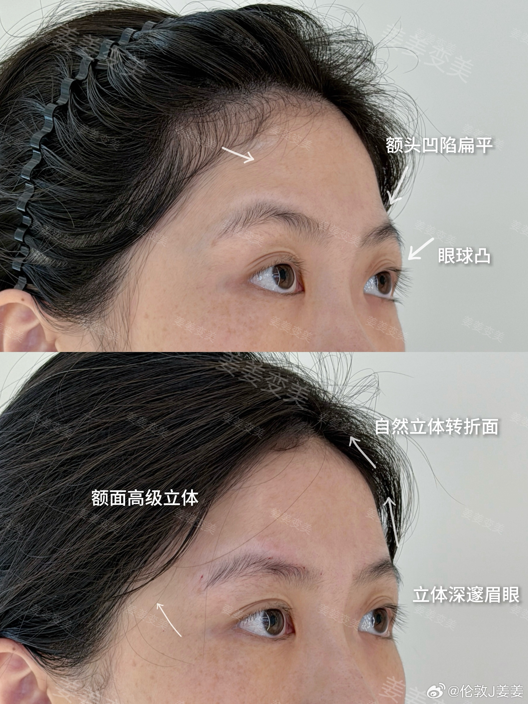 宽脸改窄很重要的部位之一：额头面诊了很多宝贝，很多人下意识觉得脸宽就是颧骨和下颌的问题，但其实额头太窄，会反向衬托颧骨更宽，比例容易变成“上窄下宽”，视觉重心往下走后，脸自然就显大了。看看图1对比优化额头饱满立体度后，上庭舒展了，中下庭自然就瘦了，脸型看着也显小了像很多明星的额头与眉弓转折点连线，都会构成一个梯形面上下呼应，整张脸看起来才更有骨骼感和层次再看我给很多宝贝设计的额头，不是把额头做得多满，而是改善上中下庭的衔接，让整个人的轮廓更顺、比例更舒服，适合自己才最重要！医美